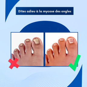 MycoPure Lumi™ - Traitement UV pour mycose des ongles