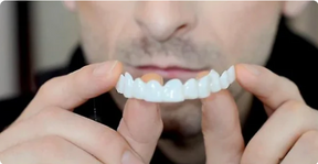 SOURIRE PARFAIT - FACETTES DENTAIRES INFÉRIEURES ET SUPÉRIEURES