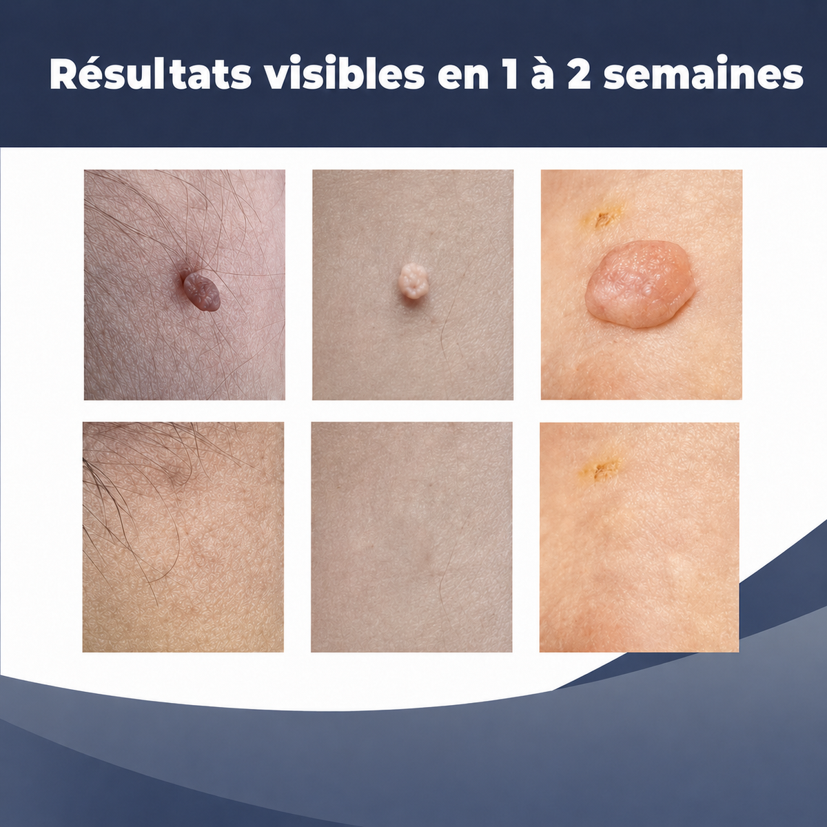 SkinClear™ | Kit Anti-Acrochordons à Domicile