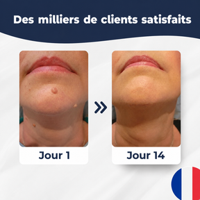 SkinClear™ | Kit Anti-Acrochordons à Domicile